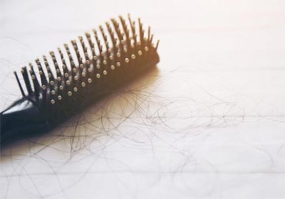 انواع مختلف ریزش مو در زنان