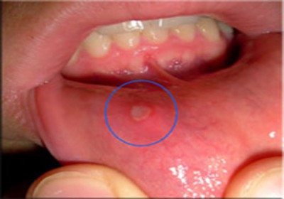 آفت دهان چگونه اتفاق می‌افتد و درمان آن چیست؟