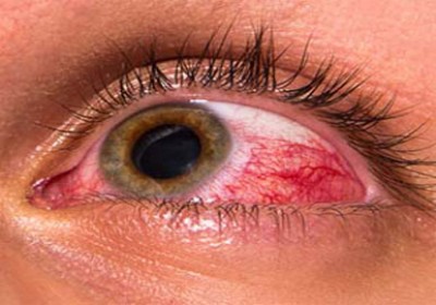 عفونت چشمی با لنزهای تماسی