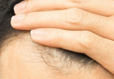 دلایل ریزش مو و راهکار درمان ریزش مو