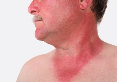 نحوه انتخاب ضد آفتاب و استفاده از ضد آفتاب ها