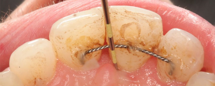 چه کارهایی باعث تخریب و پوسیدگی دندان می‌شود؟
