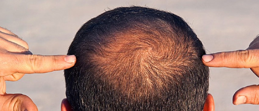 دلایل ریزش مو و راهکار درمان ریزش مو