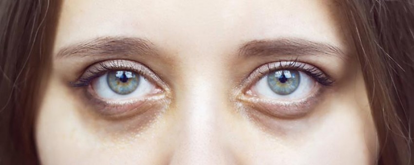 چه عواملی باعث تیرگی اطراف چشم شما میشود؟