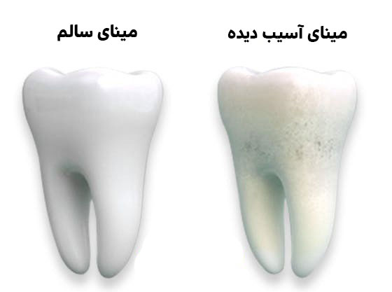 چه عواملی به مینای دندادن آسیب وارد می کند؟
