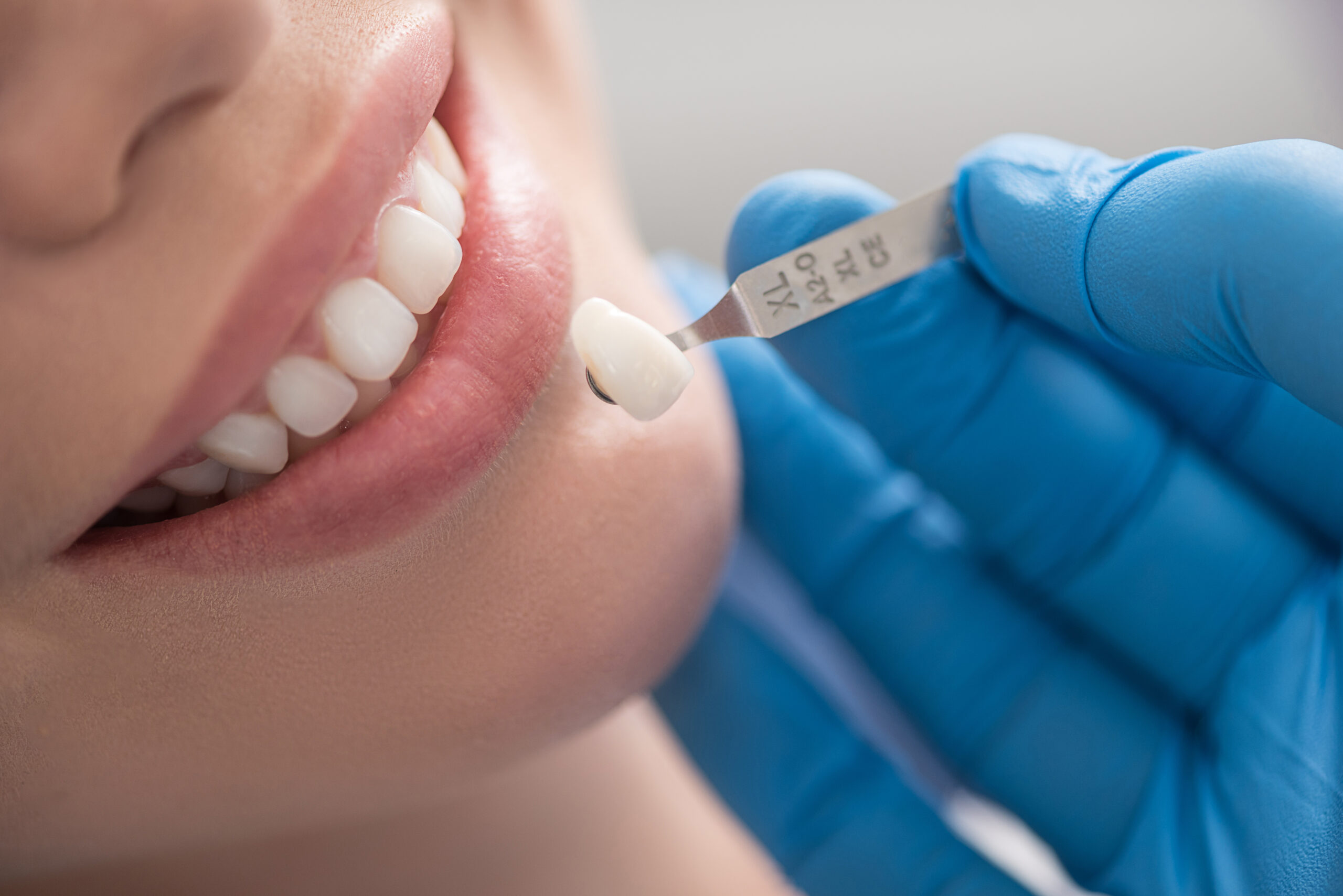 مینای دندان تحلیل رفته را چگونه درمان کنیم؟