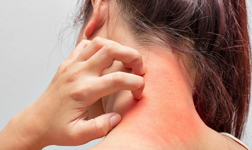 اگزما پوستی چیست و چگونه درمان میشود؟