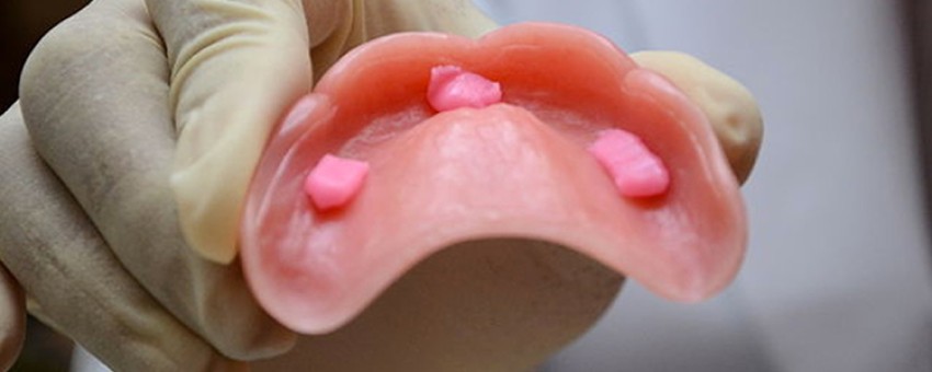 چسب دندان مصنوعی چیست؟ و انواع آن + روش استفاده