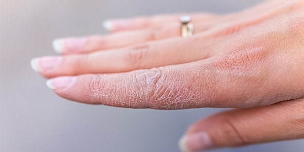 رابطه کمبود ویتامین و ‌پوسته پوسته شدن دست‌ها