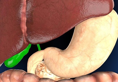 سرطان کیسه صفرا + بهترین روش درمان