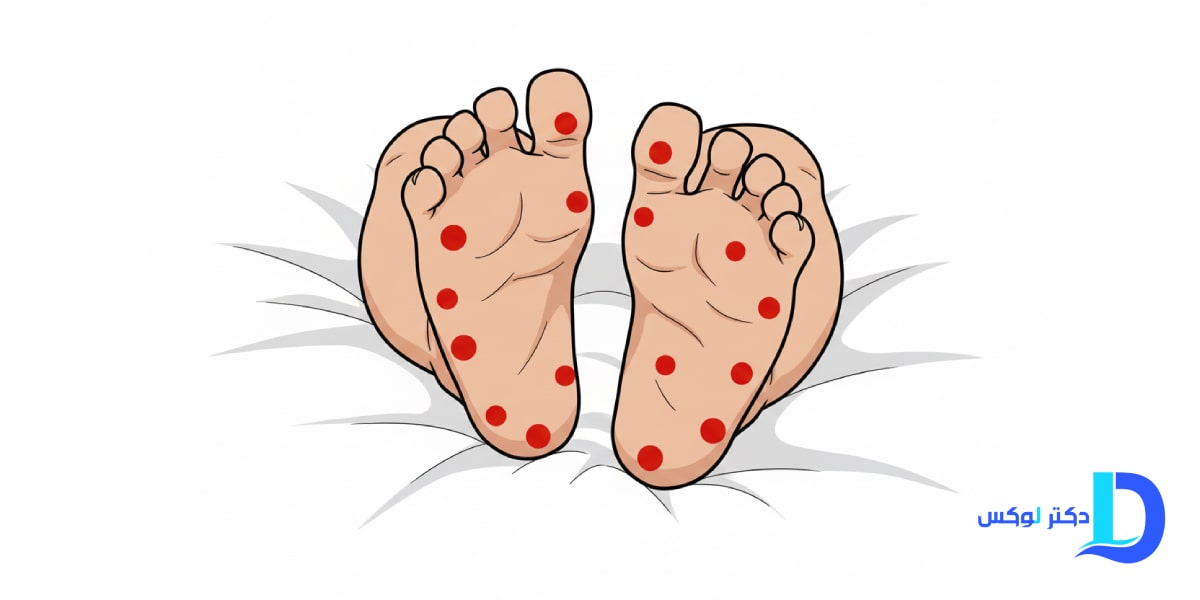 تفاوت تب برفکی با بیماری دست، پا و دهان