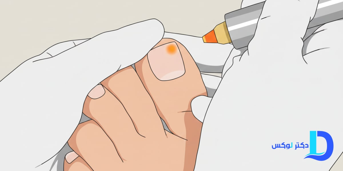 لیزر درمانی قارچ ناخن ضخیم و زرد