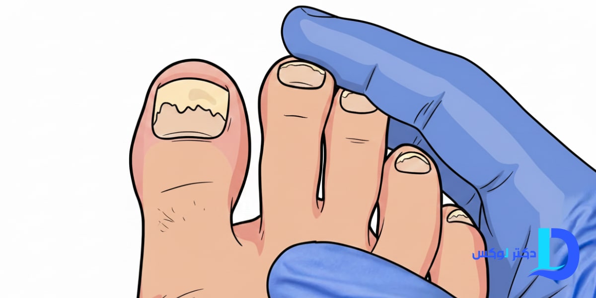 چرا عفونت قارچی ناخن پا بازمی‌گردد؟