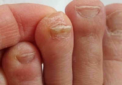 درمان قارچ ناخن پا | راهکارهای قطعی، سریع و جلوگیری از بازگشت