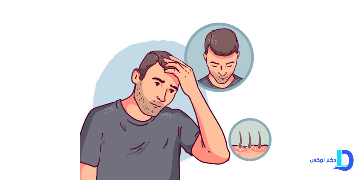 چگونه اثربخشی شامپو کتوکونازول را دوچندان کنیم؟